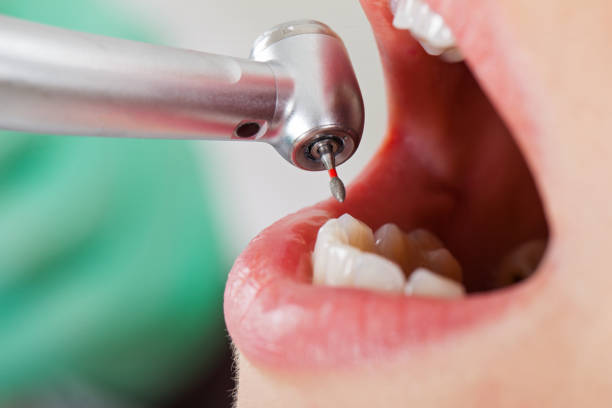 Best Emergency Dental Extractions in Ville Ptte, LA